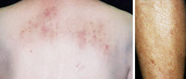 （左）皮膚掻痒症　（右）皮脂欠乏症出典：ヒフノコトサイト